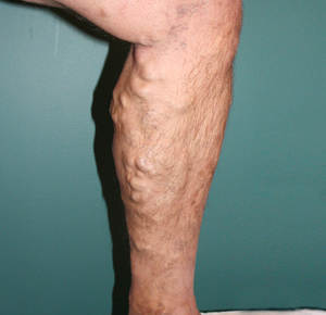 Example of varicose veins before treatment.