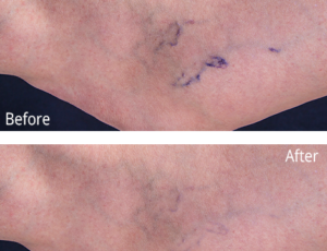 Vein before and after photo